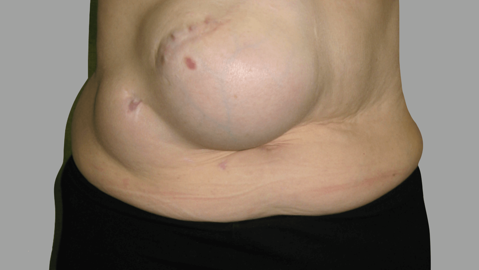 David-Floyd-abdominal-surgery-complex-hernia