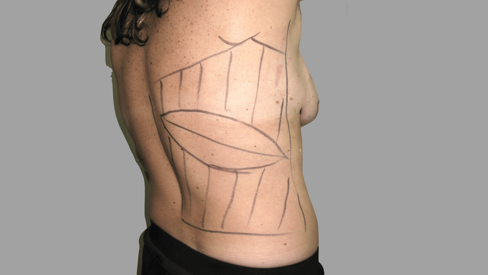 David-floyd-breast-reconstruction-immediate-LD