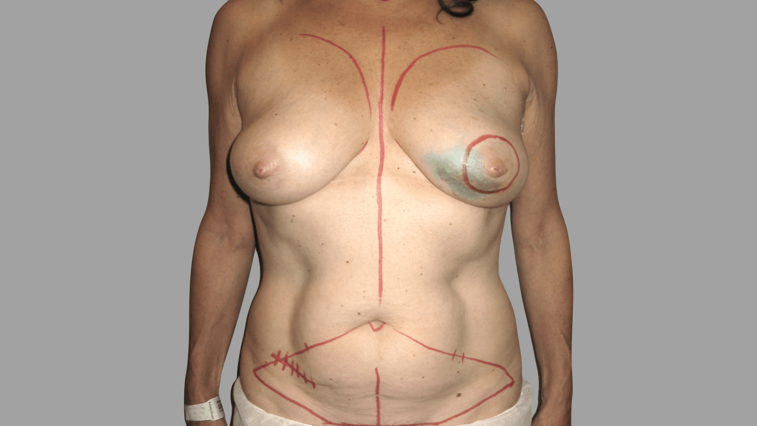 David-floyd-breast-reconstruction-immediate-diep